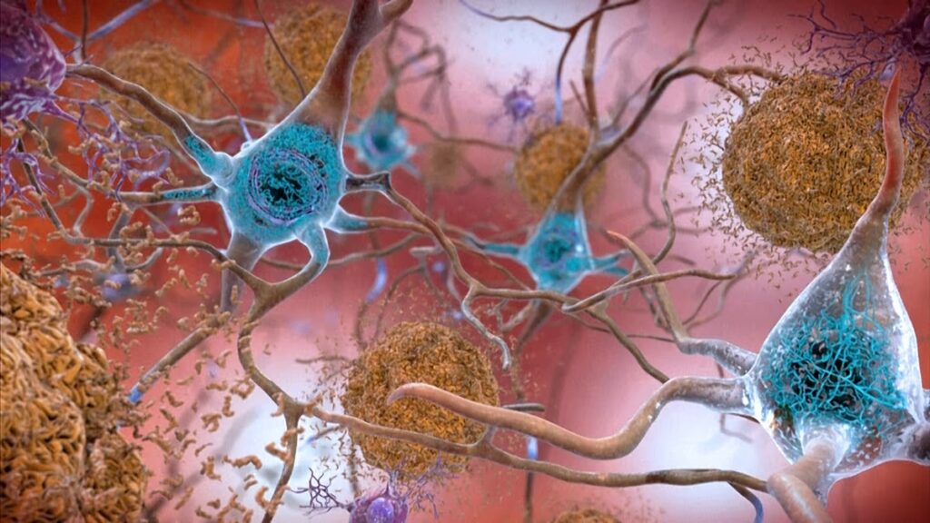 A vérvizsgálat korán jelezheti az Alzheimer-kór kockázatát. De mennyire megbízható?